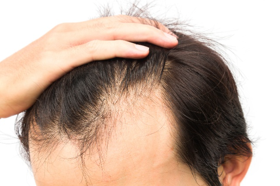 植物养发馆：为什么头皮薄会掉头发？导致头皮薄的主要原因有那些？
